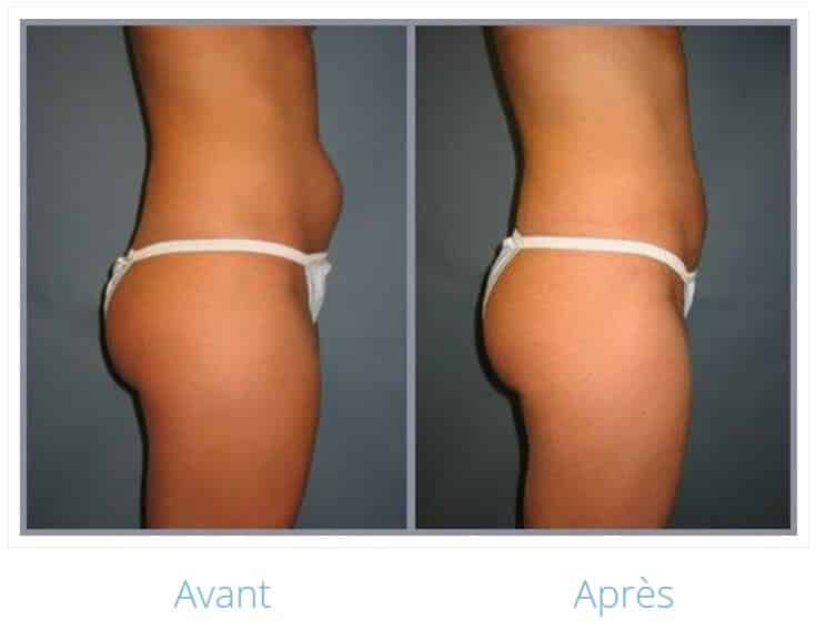 Photos avant après une liposuccion en Tunisie