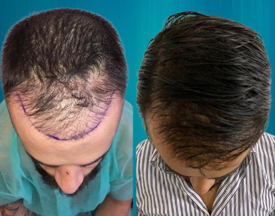 Greffe cheveux Paris